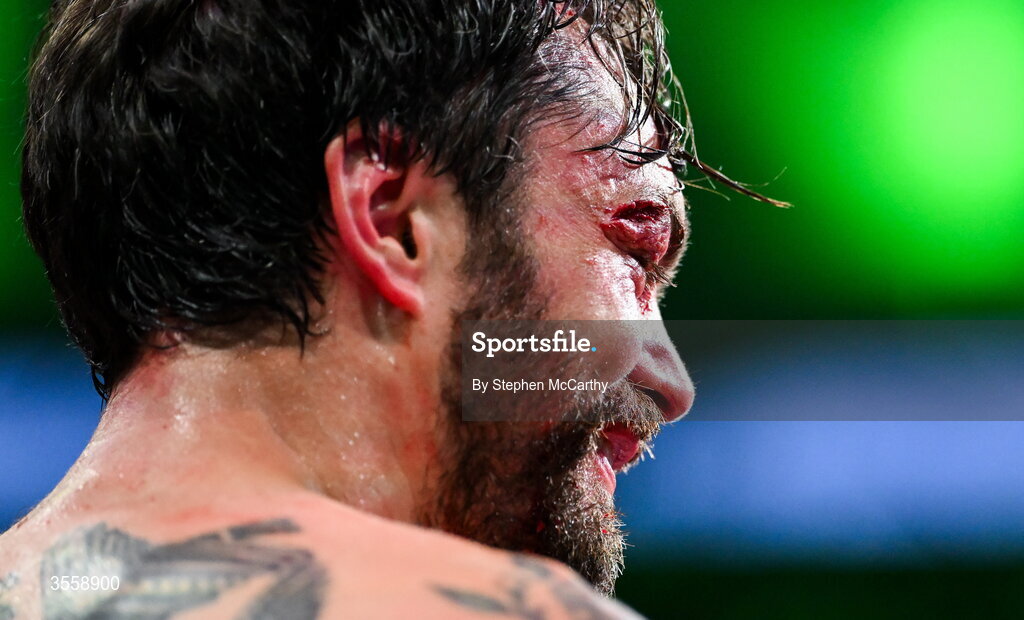 5 September 2026; (EDITORS NOTE: Image contains graphic content) Tyrone McKenna after his welterweight bout defeat against Paddy Donovan at the Once Upon A Time fight night in Croke Park, Dublin. Photo by Stephen McCarthy/Sportsfile