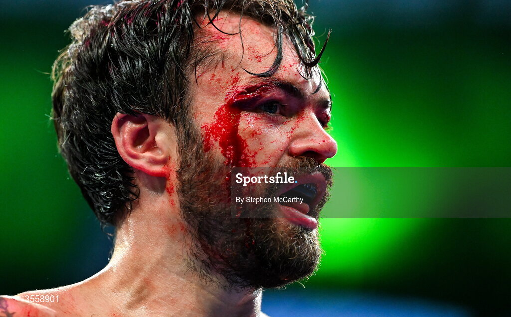5 September 2026; (EDITORS NOTE: Image contains graphic content) Tyrone McKenna after his welterweight bout defeat against Paddy Donovan at the Once Upon A Time fight night in Croke Park, Dublin. Photo by Stephen McCarthy/Sportsfile