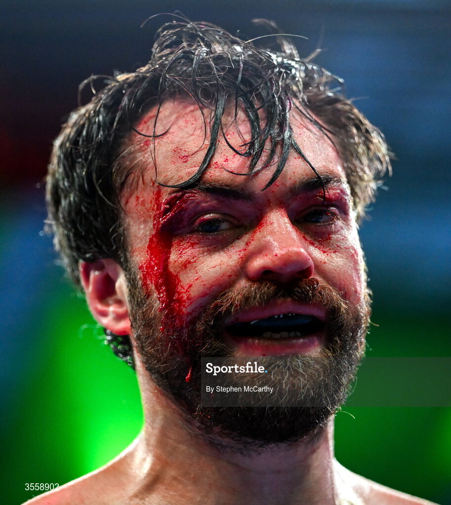 5 September 2026; (EDITORS NOTE: Image contains graphic content) Tyrone McKenna after his welterweight bout defeat against Paddy Donovan at the Once Upon A Time fight night in Croke Park, Dublin. Photo by Stephen McCarthy/Sportsfile