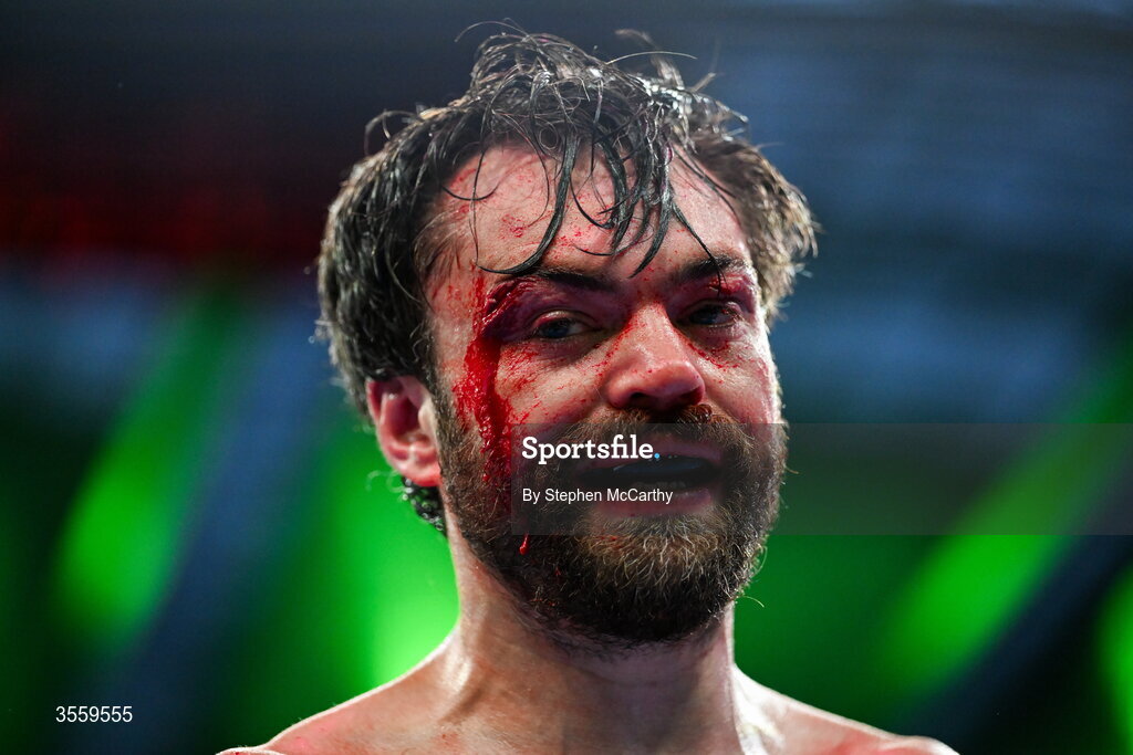 5 September 2026; (EDITORS NOTE: Image contains graphic content) Tyrone McKenna after his welterweight bout defeat against Paddy Donovan at the Once Upon A Time fight night in Croke Park, Dublin. Photo by Stephen McCarthy/Sportsfile