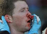 17 January 2010; Tony Taylor, Sligo, receives medical attention on the sideline after a bloody nose. Connacht FBD League, Section B, Round 1, Galway v Sligo, Tuam Stadium, Tuam, Co. Galway. Picture credit: Ray Ryan / SPORTSFILE